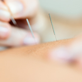Akupunktur OBC